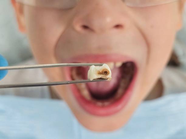 Best Broken Tooth Emergency  in Perryville, MO